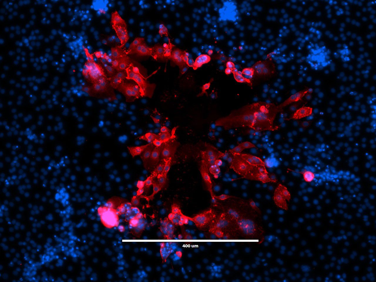 “Beauty Is Infectious.” Immunofluorescence image of a virus plaque formed by human metapneumovirus (HMPV) in LLC-MK2 cells. HMPV (red) and nucleus (DAPI, blue). Image courtesy of Jiuyang Xu (visting scholar, Tsinghua University School of Medicine) and John V. Williams, Department of Pediatrics, University of Pittsburgh.
